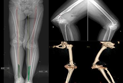 Total knee arthroplasty exhibits satisfactory long-term clinical efficacy in the treatment of hemophilia patients with stiff knees